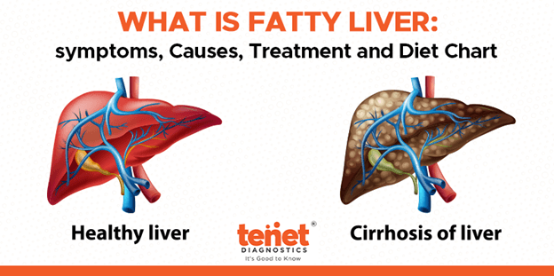 Fatty Liver 1